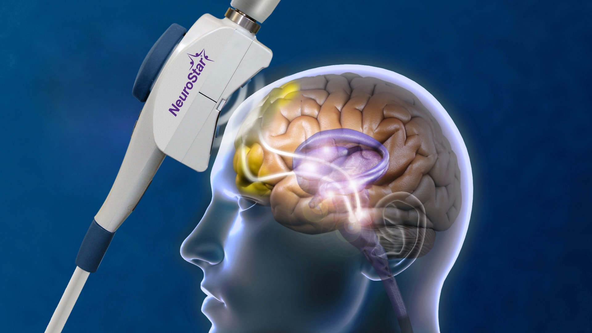 NeuroStar TMS coil targeting the brain's mood-regulation region — how transcranial magnetic stimulation works